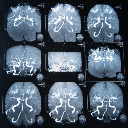 Imagen de resonancia magnética del cerebro para el diagnóstico
