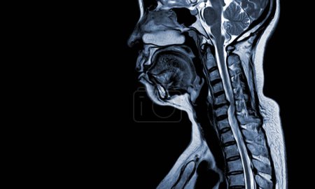 MRT (1,5 Tesla) der Halswirbelsäule wurde mittels sagittaler T1W Mäßige Kompression des Rückenmarks bei C5-6 (6 mm in AP) mit Myelopathie durchgeführt .