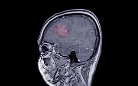 MRI BRAIN Finding of meningioma arising from anterior falx cerebri, extending to bilateral frontal regions, with adjacent minimal perilesional edema at the left frontal lobes, Medical image concept.