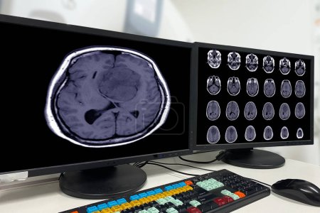MRT BRAIN Nachweis eines Meningioms aus dem vorderen Falx cerebri, das sich auf bilaterale Frontalregionen erstreckt, mit angrenzenden minimalen perilesionalen Ödemen an den linken Stirnlappen, medizinisches Bildkonzept.