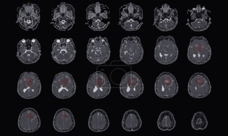 Téléchargez les photos : IRM BRAIN Constatation d'un méningiome provenant d'un falx cérébral antérieur, s'étendant aux régions frontales bilatérales, avec œdème périlésional minimal adjacent aux lobes frontaux gauche, concept d'image médicale. - en image libre de droit