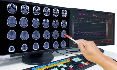 Foto de Glioblastoma, Metástasis cerebral, RM Cerebro El médico señaló la ubicación del tumor cerebral en la pantalla de la computadora - Imagen libre de derechos