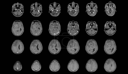 Foto de RM Cerebro Vistas axiales .para evaluar el tumor cerebral. Glioblastoma, masa de isodensidad de metástasis cerebral con margen indefinido y edema circundante en el lóbulo frontal derecho. - Imagen libre de derechos