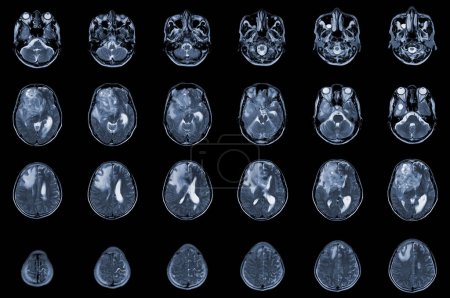 Photo for MRI Brain Axial views .to evaluate brain tumor. Glioblastoma, brain metastasis isodensity mass with an ill-defined margin and surrounding edema at the right frontal lobe. - Royalty Free Image