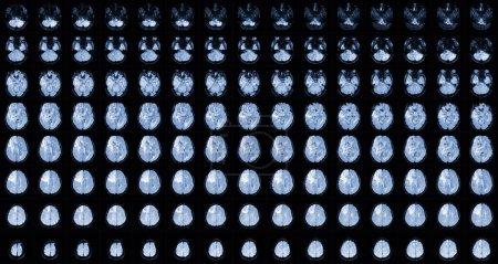 Foto de RM Cerebro Vistas axiales .para evaluar el tumor cerebral. Glioblastoma, masa de isodensidad de metástasis cerebral con margen indefinido y edema circundante en el lóbulo frontal derecho. - Imagen libre de derechos
