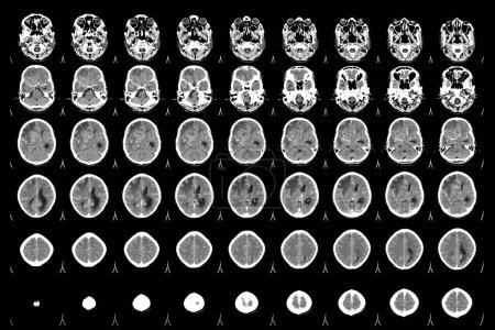 Foto de Tomografía computarizada Cerebro Vista axial .para evaluar el tumor cerebral. Glioblastoma, masa de isodensidad de metástasis cerebral con margen indefinido y edema circundante en el lóbulo frontal derecho. - Imagen libre de derechos