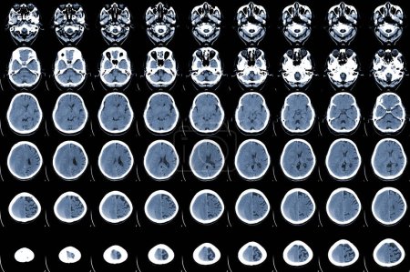 Foto de CT Scan brain acute on top subacute subdural hematoma (SDH) along left cerebral hemisphere,Education and medical healthcare concept. - Imagen libre de derechos