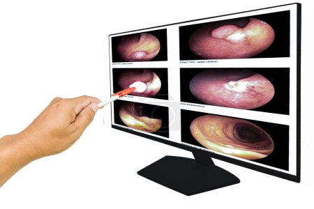 Téléchargez les photos : Gros plan Le médecin signale l'écran de l'ordinateur, le rapport d'endoscopie gastro-intestinale, l'imagerie médicale EGD à la recherche de structures dans l'œsophage. - en image libre de droit