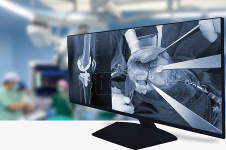 Röntgen des Knies, verschwommene Ärzte, die im Hintergrund des Operationssaals eine komplette Knieprothese vornehmen. Orthopäden setzen Instrumente zur Behandlung der Arthrose im Endstadium ein. Medizinisches Konzept.