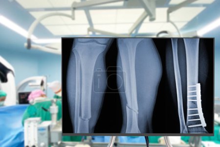Téléchargez les photos : Radiographie des jambes. Blurry Traumatologie chirurgie orthopédique salle d'opération de l'hôpital pour l'opération des jambes. Santé médicale et éducation concept - en image libre de droit