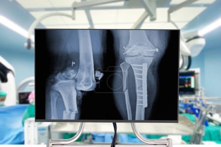 Téléchargez les photos : Radiographie de la jambe et du genou Blurry Traumatologie chirurgie orthopédique salle d'opération de l'hôpital pour l'opération des jambes. Santé médicale et éducation concept - en image libre de droit