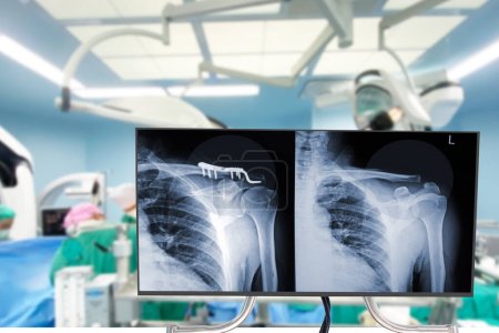 Foto de Fractura ósea de clavícula de rayos X tratada mediante cirugía y fijación de placas (ORIF) Cirugía ortopédica de traumatología borrosa sala de operaciones del hospital para la operación ósea. Concepto de salud y educación médica - Imagen libre de derechos