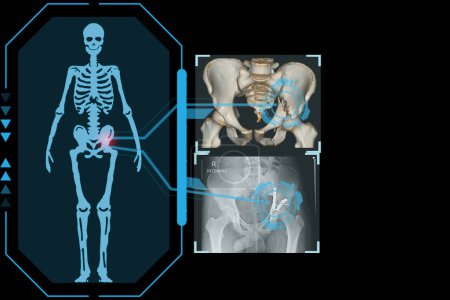 Foto de Examina una placa holográfica digital tecnológica que representa el cuerpo del paciente, Fractura transversal de la pelvis de acetábulo, Concepto: Medicina futurista, Concepto de tecnología médica. - Imagen libre de derechos