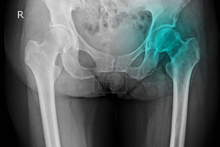 Photo for Pelvis and hip x-ray of a patient with hip pain showing avascular necrosis on the left sides of the hips and secondary osteoarthritis. The patient needed a total hip replacement - Royalty Free Image