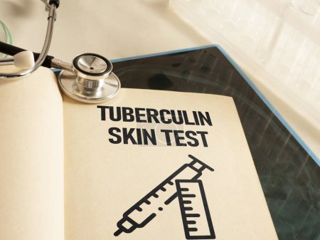 Foto de La prueba cutánea de la tuberculina se muestra usando un texto - Imagen libre de derechos