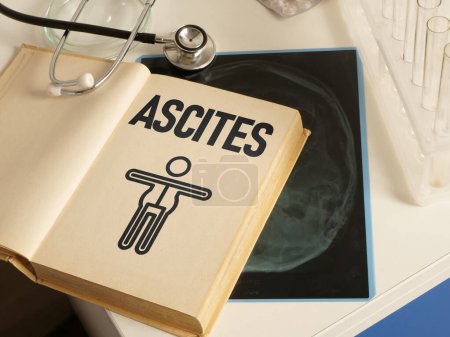 Ascites is shown using a text and picture