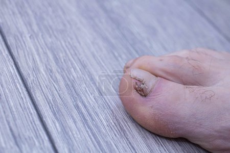 Foto de Aplicando un agente antifúngico en la uña del pie de los afectados por el primer plano del hongo, el primer plano y el fondo se difuminan con un efecto bokeh - Imagen libre de derechos