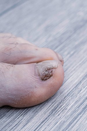 Photo for Applying an antifungal agent to the toenail of the affected by the fungus close-up, the foreground and background are blurred with a bokeh effect - Royalty Free Image