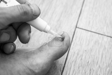applying an antifungal agent to the toenail of the affected by the fungus close-up, the foreground and background are blurred with a bokeh effect