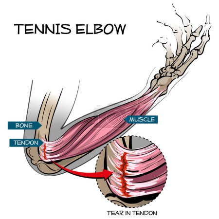 Foto de Ilustración vertical del codo de tenista - desgarro en el tendón extensor común del brazo. - Imagen libre de derechos