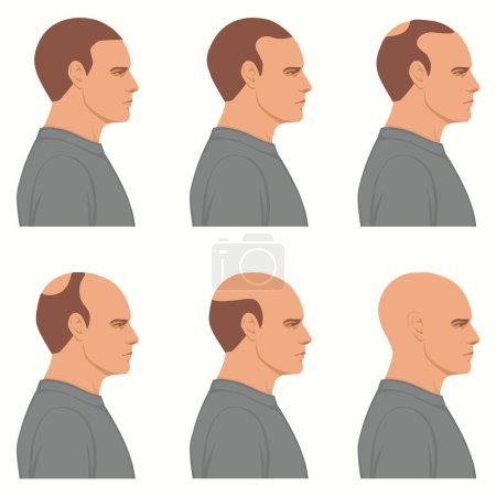 Ilustración de Cuadro informativo que muestra las etapas de pérdida de cabello para los hombres. Cabeza en negrilla desde la cubierta completa del cabello hasta una etapa final de calvicie. - Imagen libre de derechos