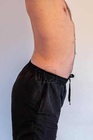 Foto de Lordosis curvature of the spine. Man with lordosis. A common body posture defect. - Imagen libre de derechos