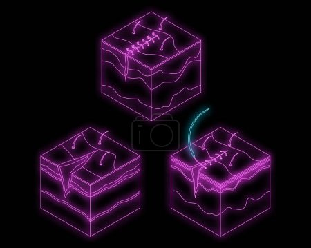 Illustration for Surgical suture icons set. Isometric set of surgical suture vector icons neon isolated on black background - Royalty Free Image