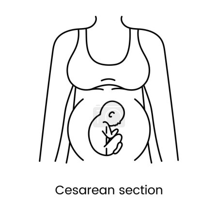 Ilustración de Cesárea sección vistas icono línea en vector, ilustración de una mujer embarazada - Imagen libre de derechos