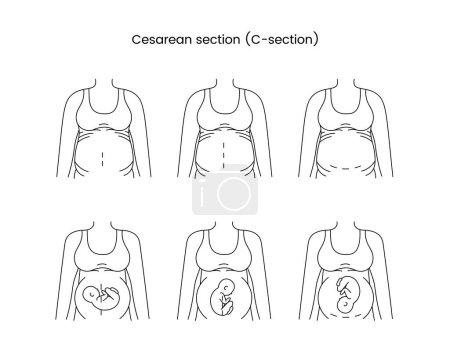 Césarienne vue section icône ligne dans le vecteur, illustration d'une femme enceinte