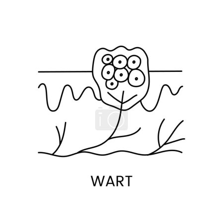 Illustration for Wart removal with laser cosmetology, line icon in vector wart in skin layers. - Royalty Free Image