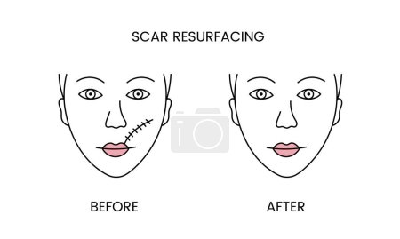 Illustration for Scar resurfacing, laser cosmetology before procedure and after applying treatment line icon in vector. Illustration of a woman with smooth clean skin and problematic skin - Royalty Free Image