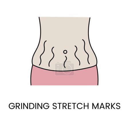 Illustration for Resurfacing stretch marks on the skin with laser cosmetology, in vector body with stretch marks on the abdomen. - Royalty Free Image