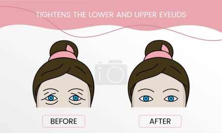 Aprieta el párpado inferior y superior, la cosmetología láser antes del procedimiento y después de aplicar el tratamiento. Ilustración de una mujer con y sin arrugas.