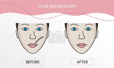Illustration for Scar resurfacing, laser cosmetology before procedure and after applying treatment in vector. Illustration of a woman with smooth clean skin and problematic skin - Royalty Free Image