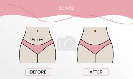 Illustration for Scar resurfacing, laser cosmetology before procedure and after applying treatment in vector. Illustration of a woman with smooth clean skin and problematic skin - Royalty Free Image