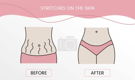 Illustration for Resurfacing stretch marks on the skin, body with stretch marks on the abdomen. Laser cosmetology before procedure and after applying treatment in vector - Royalty Free Image