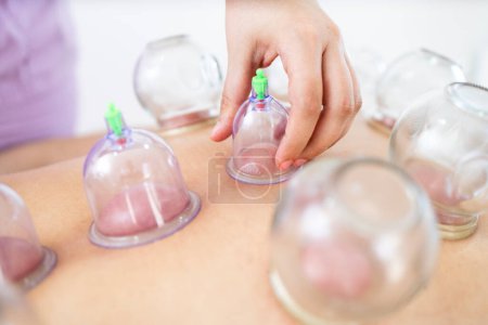 Close up view of vacuum cups filled during hijama cupping therapy.