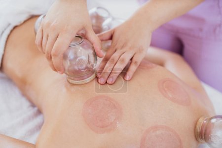 Photo for Hijama alternative medicine therapy for chronic pain relief and relaxation. Focus on vacuum cups. - Royalty Free Image