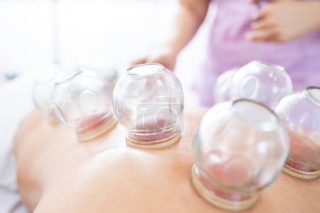 Hijama medical treatment for body relaxation and pain relief. Close up view of suction cups.