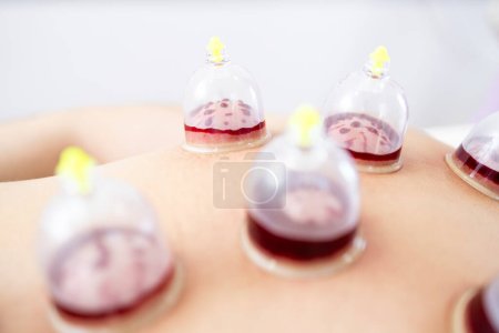 Foto de Vista de cerca de vasos de vacío llenos de sangre durante la terapia de ventosas de hijama. - Imagen libre de derechos