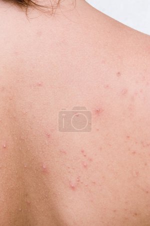 Photo for Female suffering with abult ance covering the upper back with copy space - Royalty Free Image
