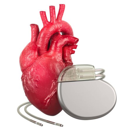 Menschliches Herz mit implantierbarem Herzgerät, 3D-Rendering isoliert auf weißem Hintergrund