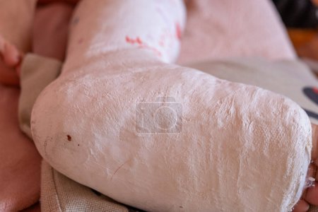 Téléchargez les photos : Vue rapprochée d'une jambe plâtrée - en image libre de droit