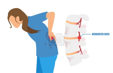 Illustration for Vector of a young woman with a low back pain and sciatica from a herniated disc. - Royalty Free Image