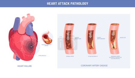 Illustration for Pathology of a heart attack and atherosclerosis medical illustration infographic - Royalty Free Image