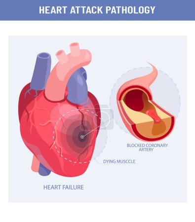 Ilustración de Ataque cardíaco y aterosclerosis ilustración médica. Vector de un corazón dañado, sección transversal de una arteria coronaria con placa aterosclerótica - Imagen libre de derechos