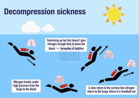 Foto de Infografía que explica la enfermedad de descompresión o la enfermedad de los buzos - Imagen libre de derechos