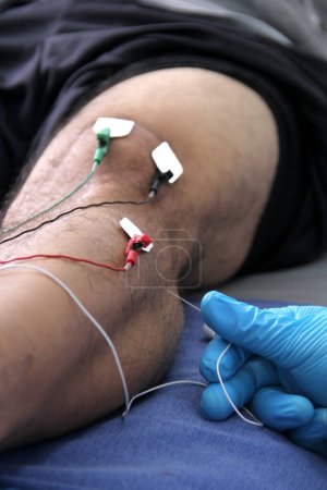 Foto de Electromyography EMG and Somatosensory Evoked Potential PEV of lower extremities, neurophysiological test applies electrical stimuli near the nerves to explore the gastroctemius muscle, calf in leg - Imagen libre de derechos