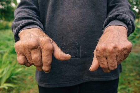 Téléchargez les photos : Les mains de l'aîné. Concept de polyarthrite rhumatoïde, d'arthrose ou de douleurs articulaires. Faiblesse des mains. - en image libre de droit