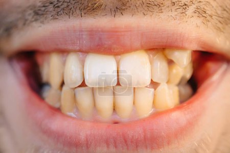 Foto de Man showing crooked growing teeth. The man needs to go to the dentist to install braces. - Imagen libre de derechos